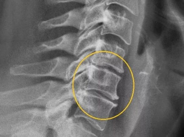 Osteocondrose da coluna cervical em uma raio X