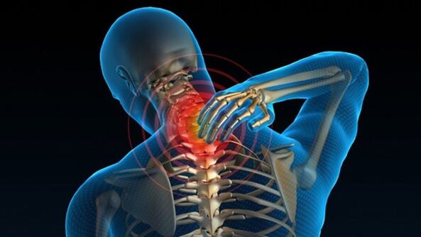 Dor ao virar o pescoço pode indicar síndrome vertebral da osteocondrose cervical