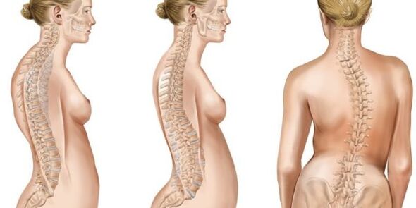 Mixagem de escoliose de discos intervertebrais