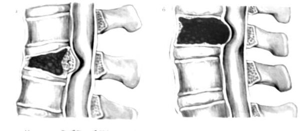 O tumor na coluna é a causa da dor nas costas