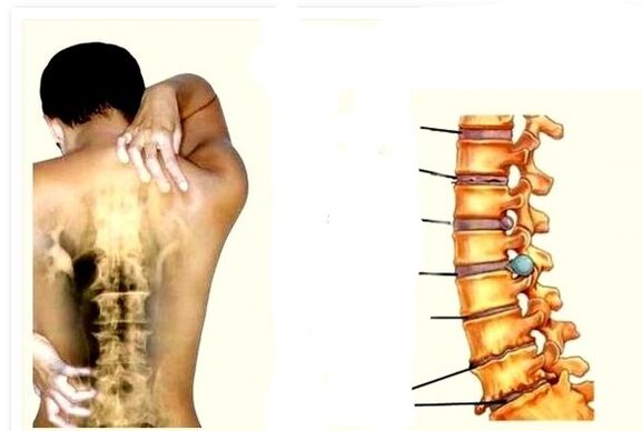 Osteocondrose é a causa da dor nas costas